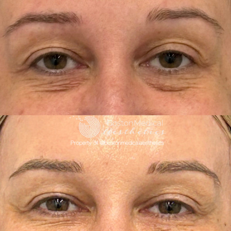 Pure PDGF+ Before & After Photo