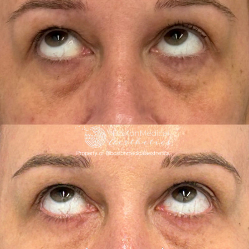 Pure PDGF+ Before & After Photo