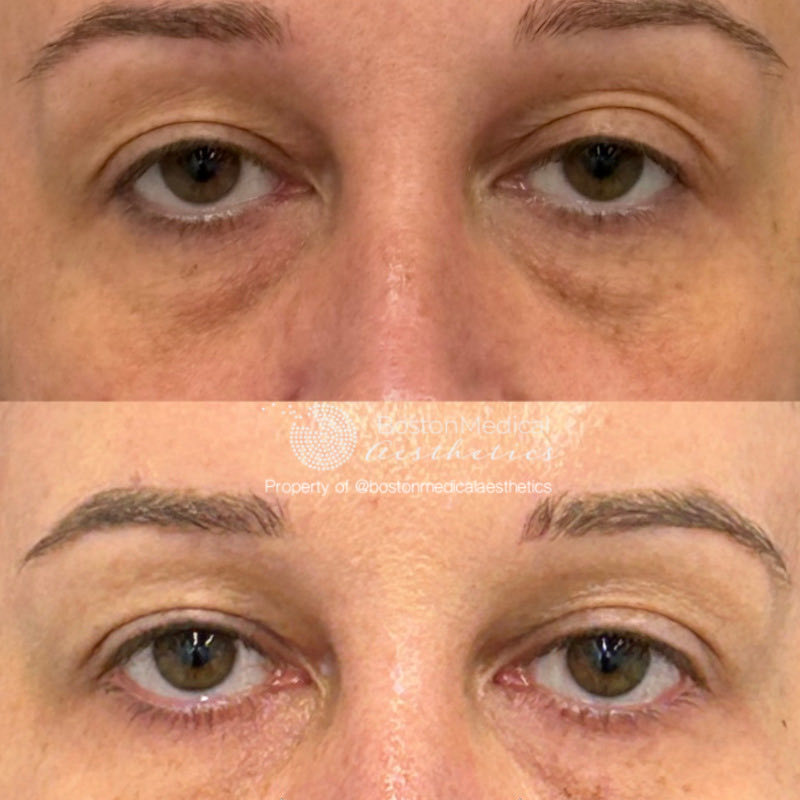 Pure PDGF+ Before & After Photo