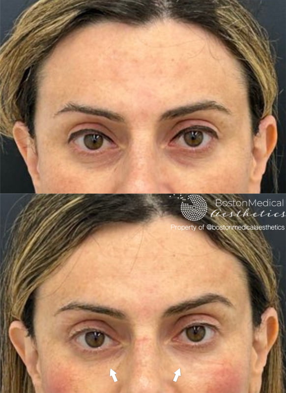 Pure PDGF+ Before & After Photo