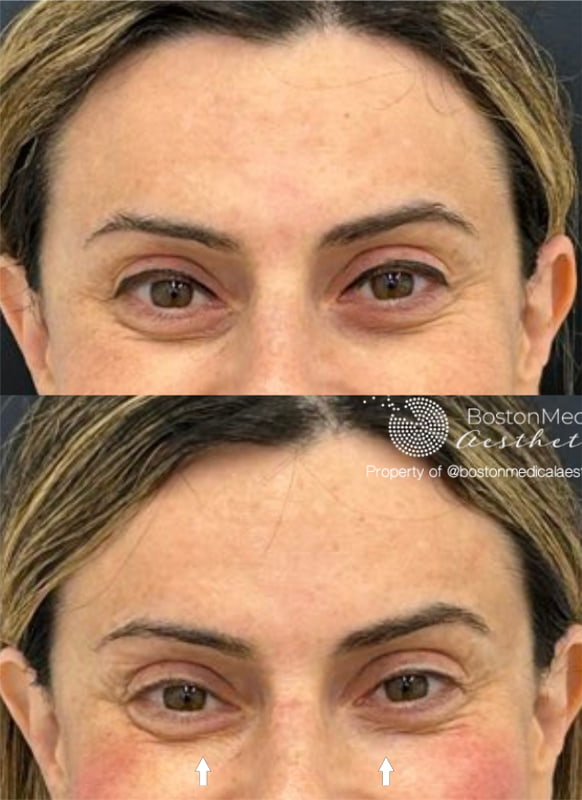 Pure PDGF+ Before & After Photo