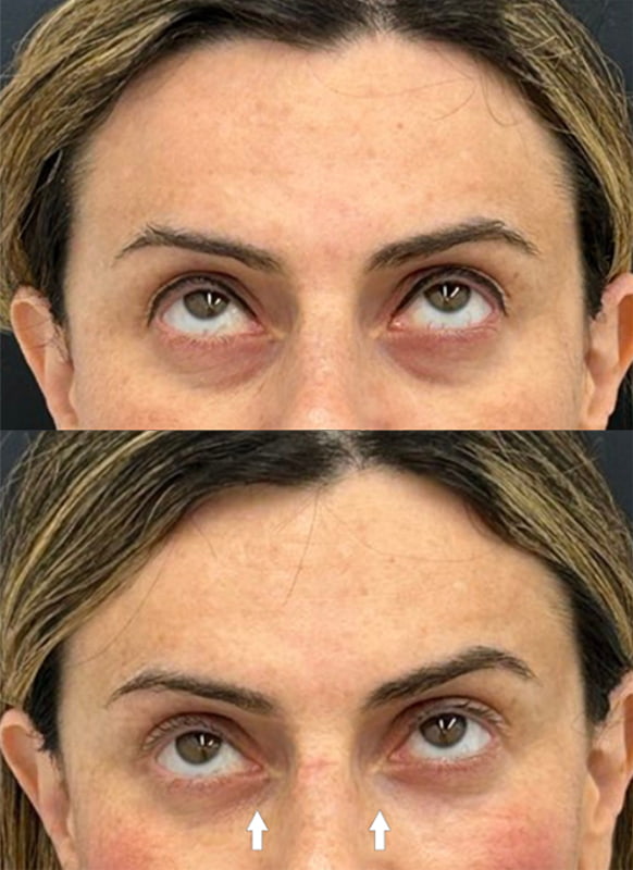 Pure PDGF+ Before & After Photo