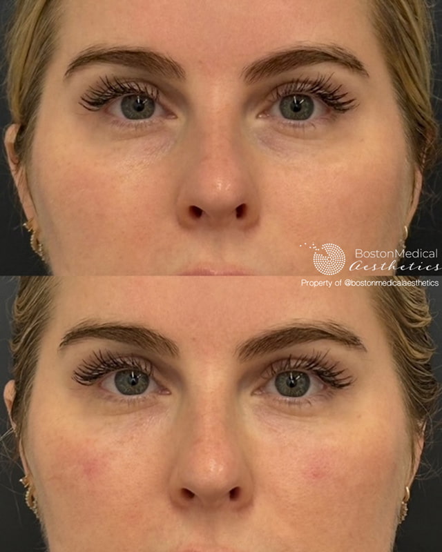 Pure PDGF+ Before & After Photo