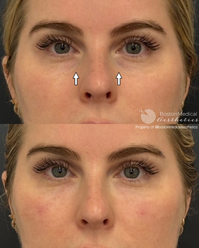 Pure PDGF+ Before & After Photo