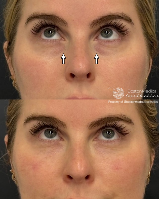 Pure PDGF+ Before & After Photo