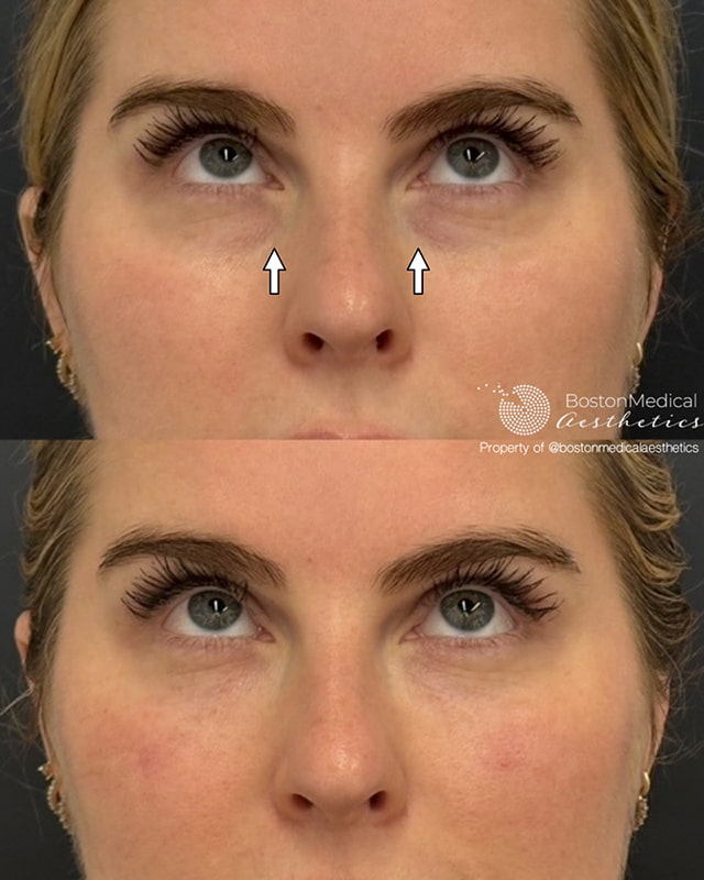 Pure PDGF+ Before & After Photo