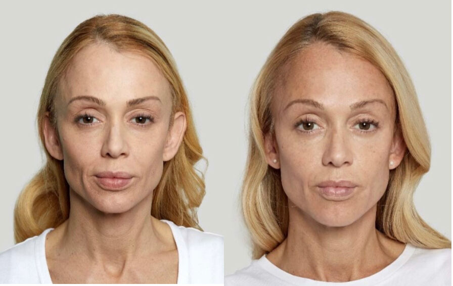 Sculptra Before & After Photo