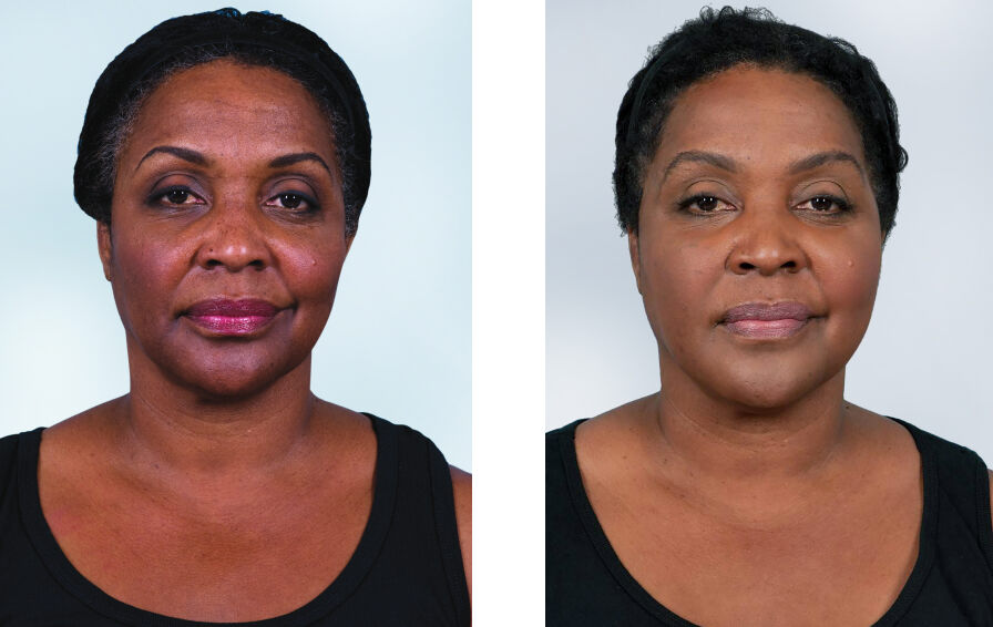 Sculptra Before & After Photo