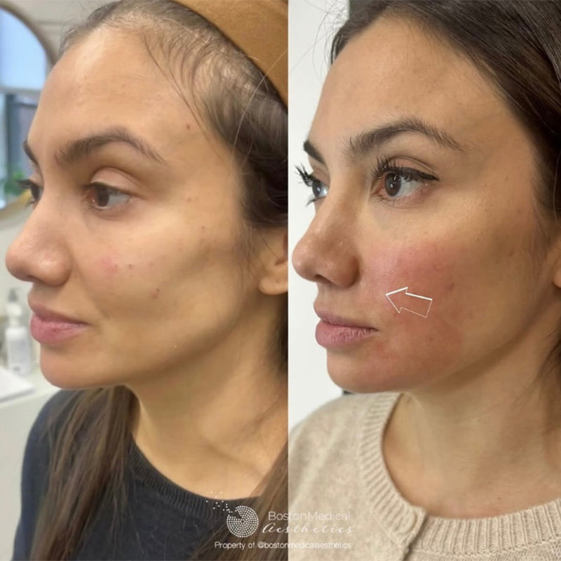 Smile Line Filler Before & After Photo