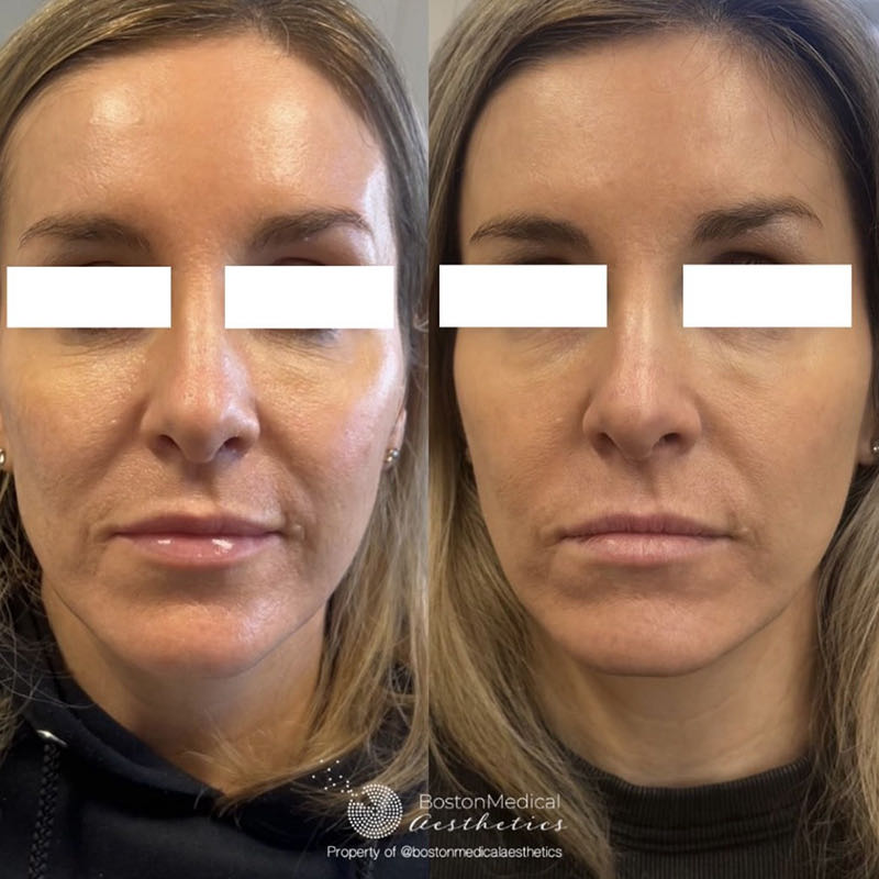 Smile Line Filler Before & After Photo