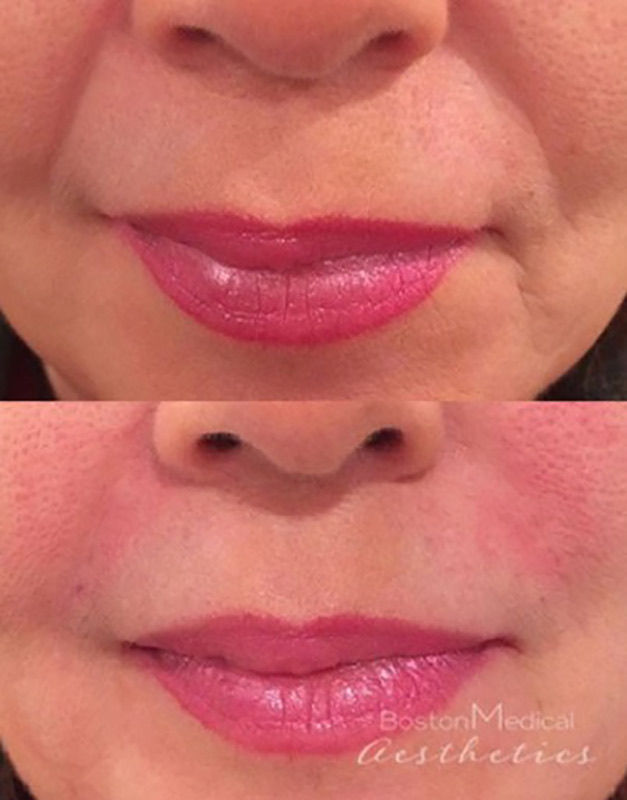 Smile Line Filler Before & After Photo