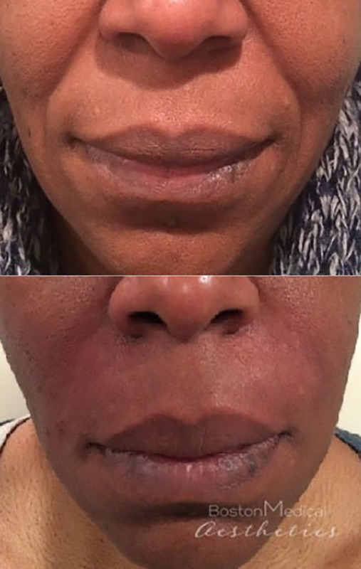 Smile Line Filler Before & After Photo