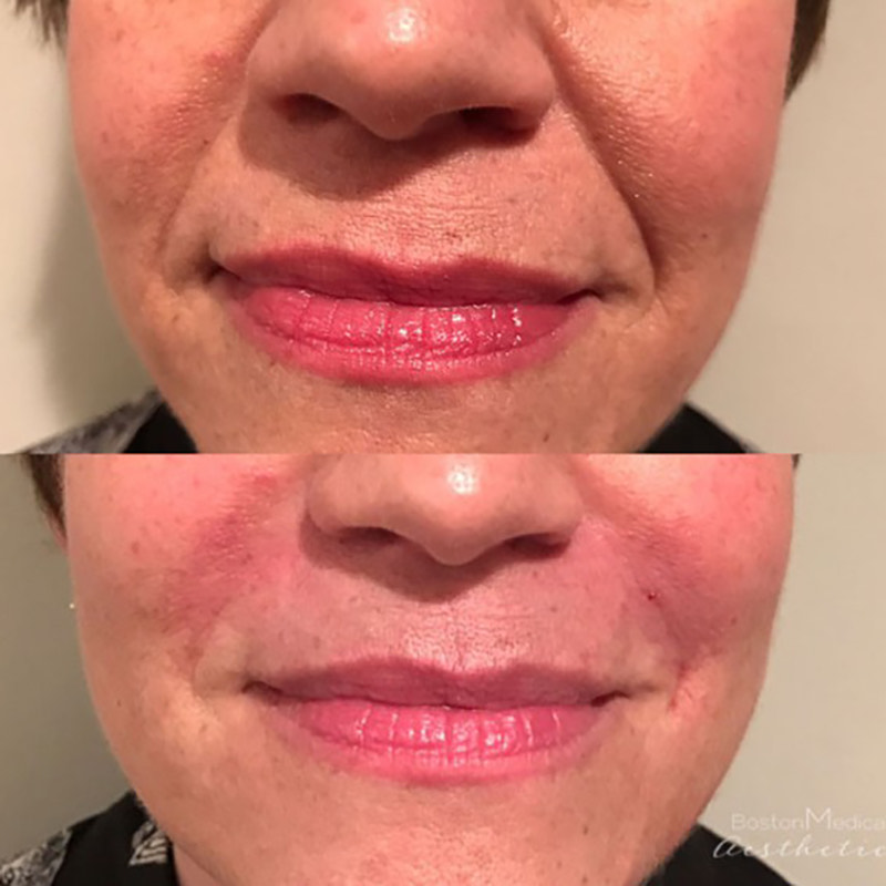 Smile Line Filler Before & After Photo