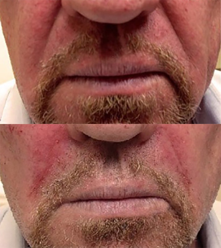 Smile Line Filler Before & After Photo