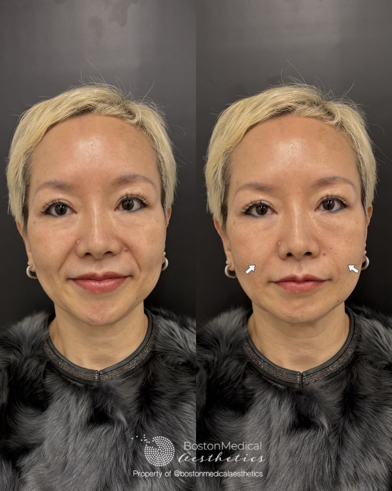 Smile Line Filler Before & After Photo