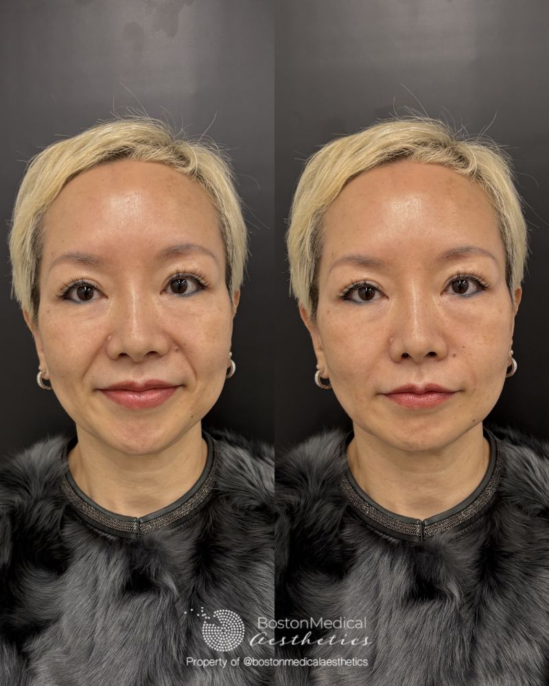 Smile Line Filler Before & After Photo