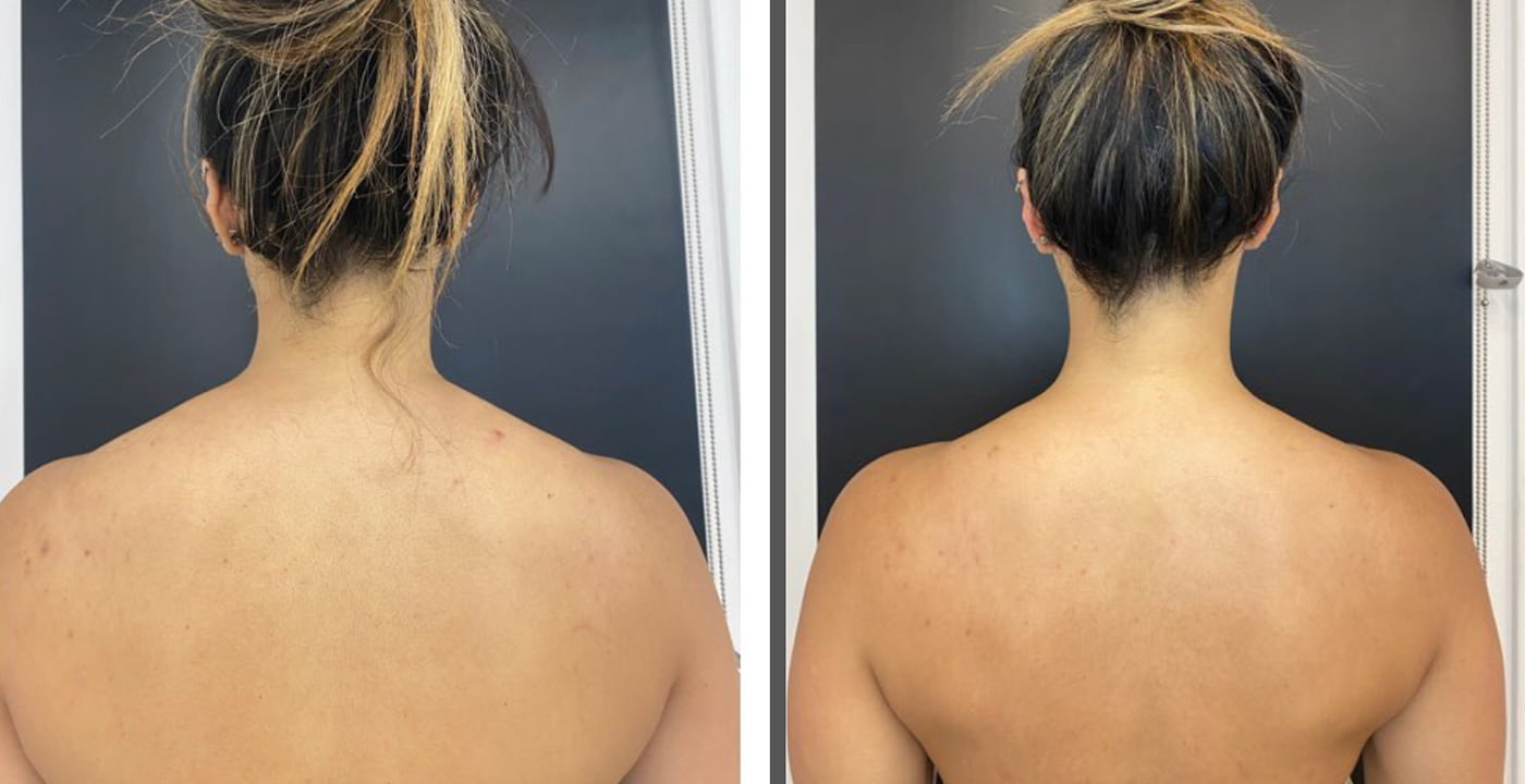 Trapezius Botox Before & After Photo