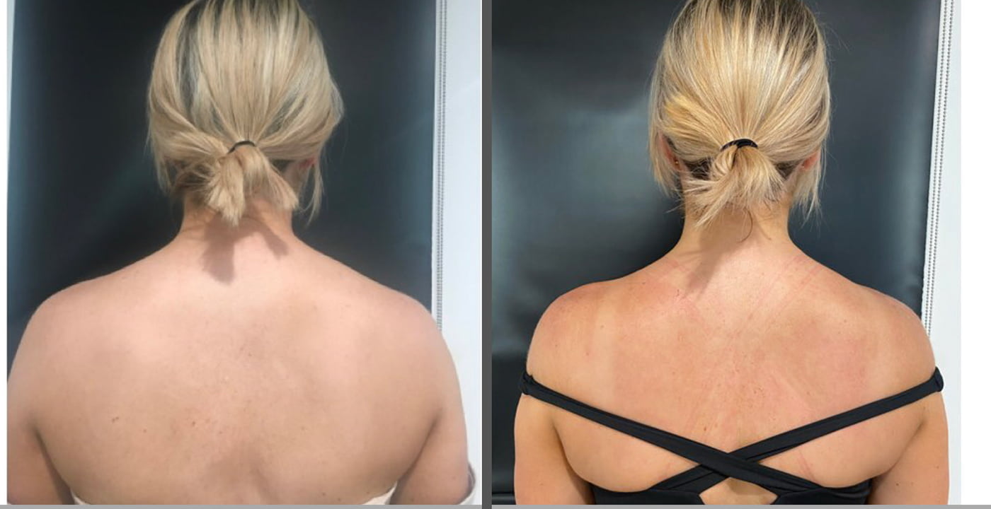 Trapezius Botox Before & After Photo