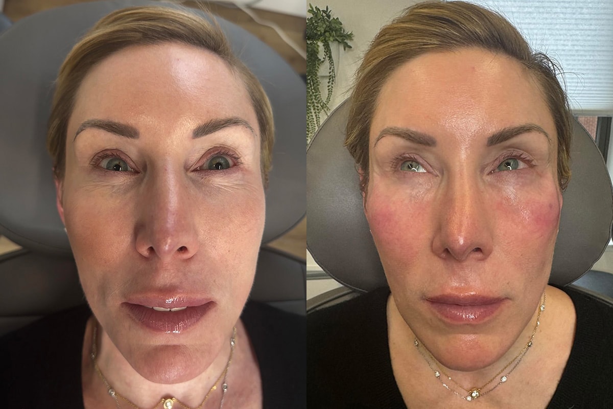 Under Eye Fillers Before & After Photo