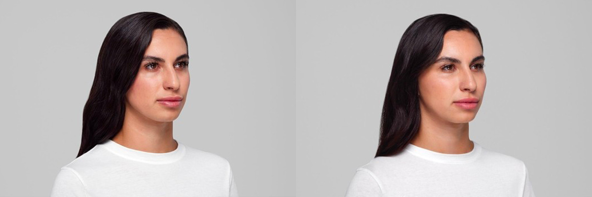 Under Eye Fillers Before & After Photo