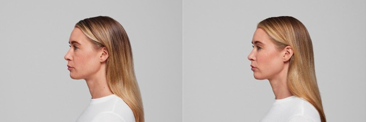 Under Eye Fillers Before & After Photo